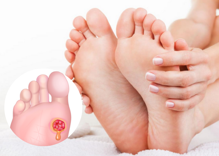 Diabetic Foot Ulcers & Infections - Velura Clinic